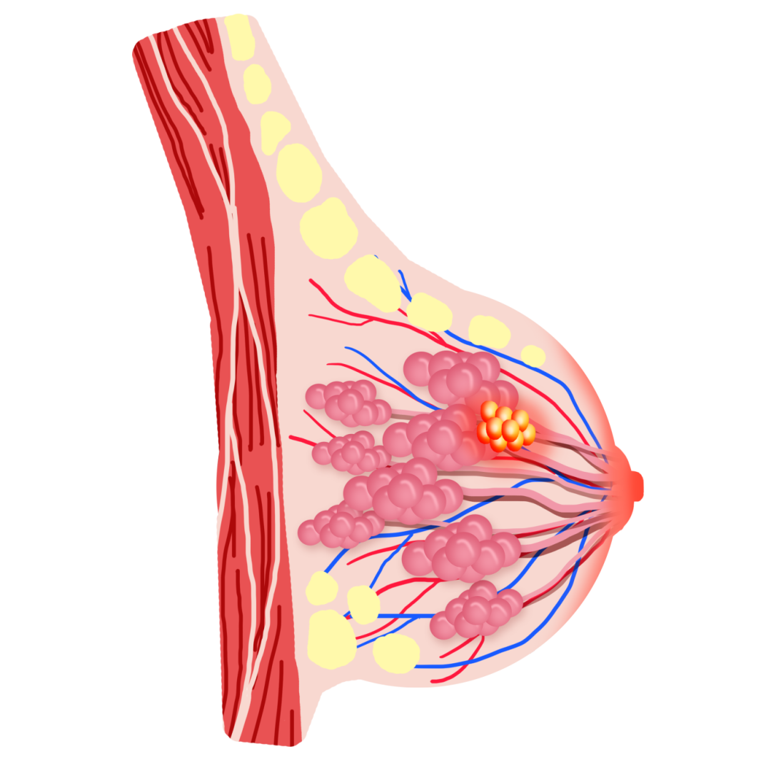 包圖網(wǎng)_19657413乳房腫瘤乳腺癌乳腺疾病.png